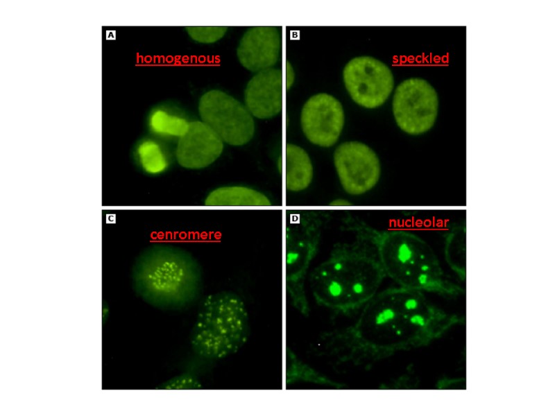 homogenous nucleolar speckled cenromere